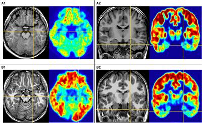 Glucose Metabolism Characteristics of Extra-Hypothalamic Cortex in Patients With Hypothalamic Hamartomas (HH) Undergoing Epilepsy Evaluation: A Retrospective Study of 16 Cases